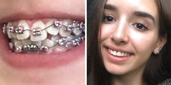 10 transformações surpreendentes de pessoas que tinham dentes fora do lugar