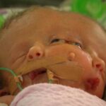 Gêmeos que nasceram com duas faces e um só corpo morrem 19 dias após o nascimento