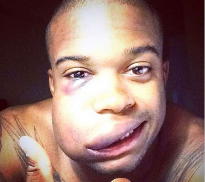 Jogador de beisebol fica com rosto deformado após tomar bolada