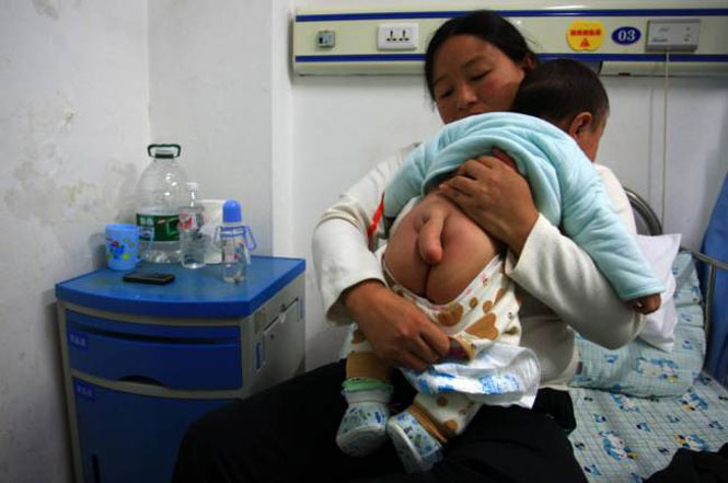 Mãe implora por cirurgia em bebê para retirada de cauda de 12 cm