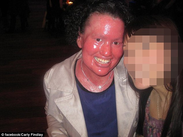 Mulher com doença rara de pele afirma que Halloween faz com que crianças temam sua aparência